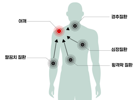 어깨통증 원인